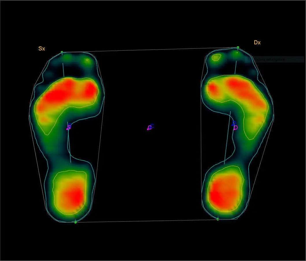 Paziente in piedi su pedana baropodometrica per l'analisi dell’appoggio plantare e postura al TB Medical Center